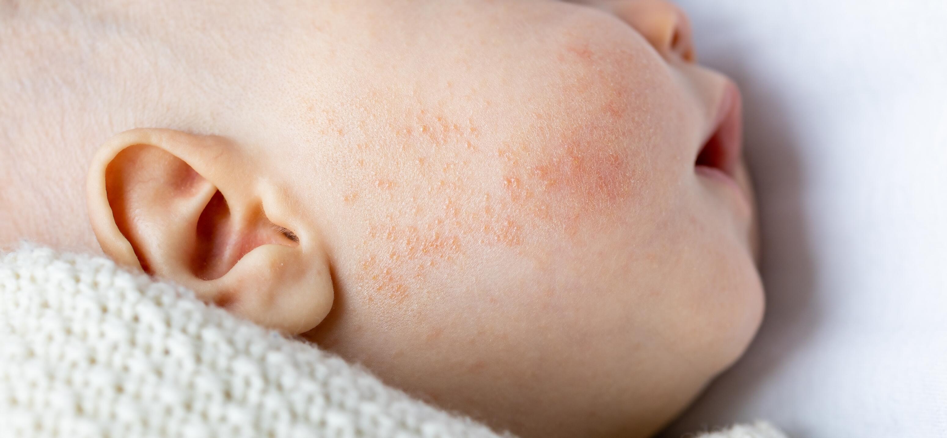 symptômes dermatite atopique